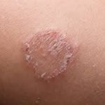 Fungal Infection