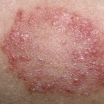 Fungal Infection