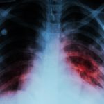 World TB Day